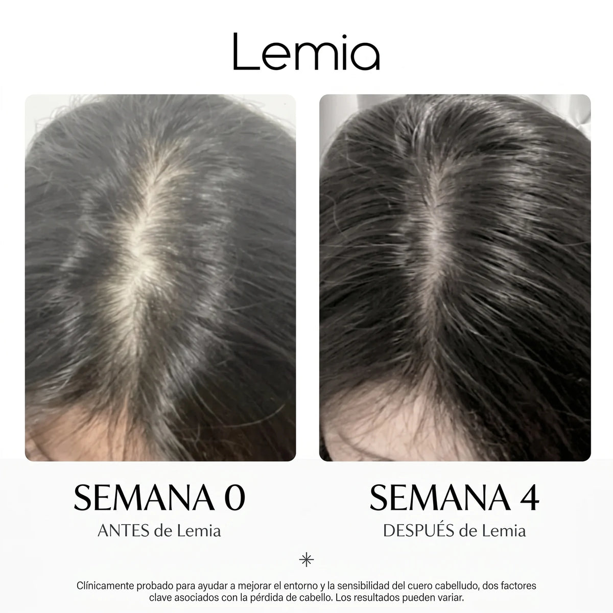 Sérum PDRN Coreano: Directo a la Raíz - Anticaída y Reactivación capilar